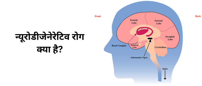 न्यूरोडीजेनेरेटिव रोग क्या है?